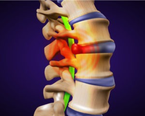 Average Settlements for Bulging Discs in Car Accidents | 24/7 Support